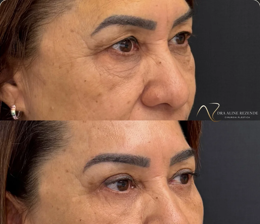 Antes e depois de blefaroplastia realizada pela Dra. Aline Rezende