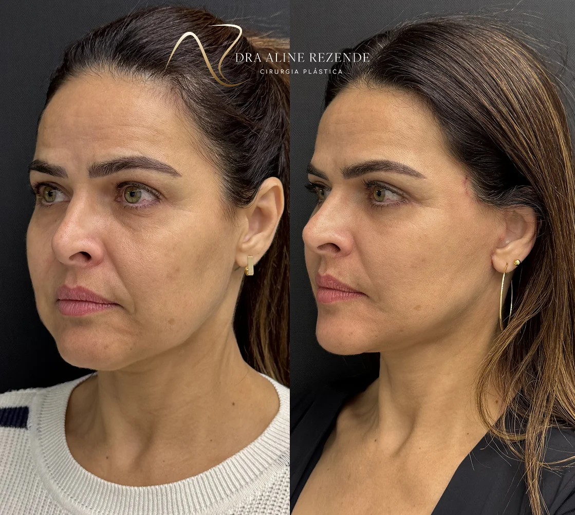 Antes e depois de facelift realizado pela Dra. Aline Rezende